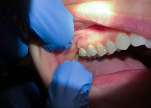 Best Emergency Root Canal Therapy in Creighton, NE